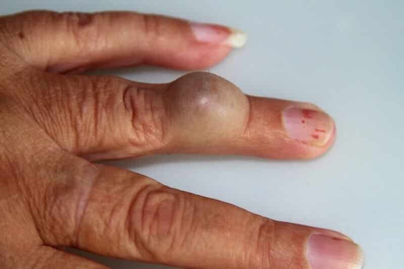 pr-eric-roulot-chirurgie-main-paris-chirurgie-doigt-kyste-au-doigt