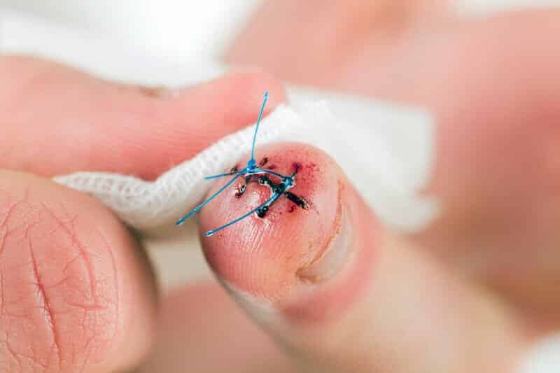 pr-eric-roulot-chirurgie-main-paris-chirurgie-doigt-plaie-au-doigt