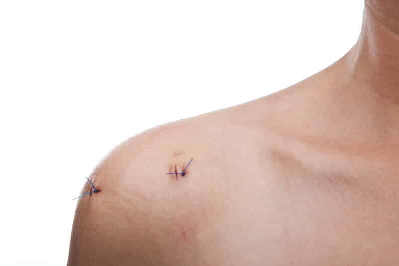 pr eric roulot - chirurgie de l épaule paris 16 - cicatrice après arthroscopie épaule droite - opération