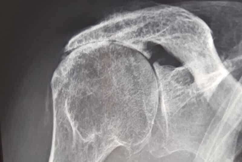 radio epaule arthrose - examen de l épaule - radiographie épaule - arthrose de l épaule droite sévère - omarthrose centrée - omarthrose excentrée