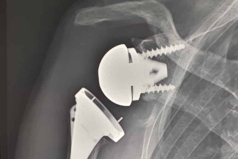 radio epaule arthrose - prothèse d épaule - prothèse inversée épaule - examen épaule après opération - chirurgie de l épaule Paris - professeur Eric Roulot