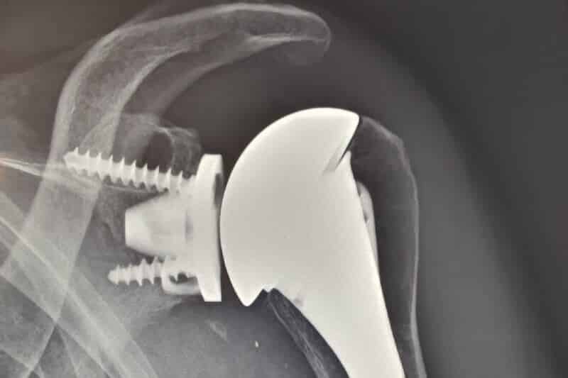 radio epaule arthrose - examen épaule - radiographie épaule après opération omarthrose - prothèse d épaule - prothèse anatomique d épaule gauche
