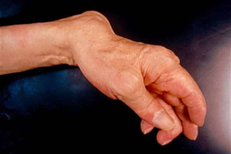 Maladie de la main et maladie du Pathologies non traumatiques Pr Eric Roulot