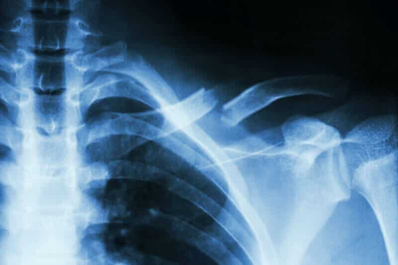 radio de l épaule - fracture de la clavicule - chirurgie réparatrice de l épaule paris 16 - clinique jouvenet chirurgien orthopédiste