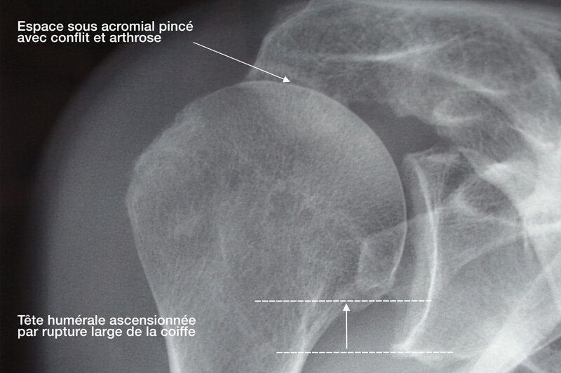 radiographie épaule - examen coiffe des rotateurs - conflit sous acromial epaule