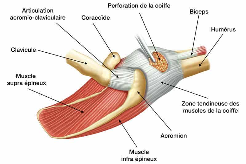 anatomie de l'épaule - rupture partielle coiffe des rotateurs -