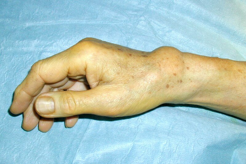 Ténosynovite du long extenseur du pouce droit - boule au niveau du poignet