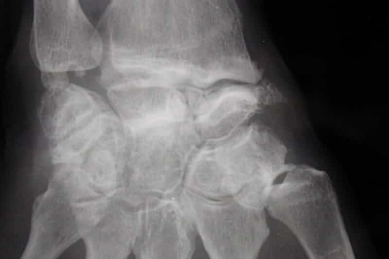 tendinite de quervain tenosynovite quervain tendinite pouce- radiographie arthrose deformante du pouce-tenosynovite du pouce-la stiloidite-radiale