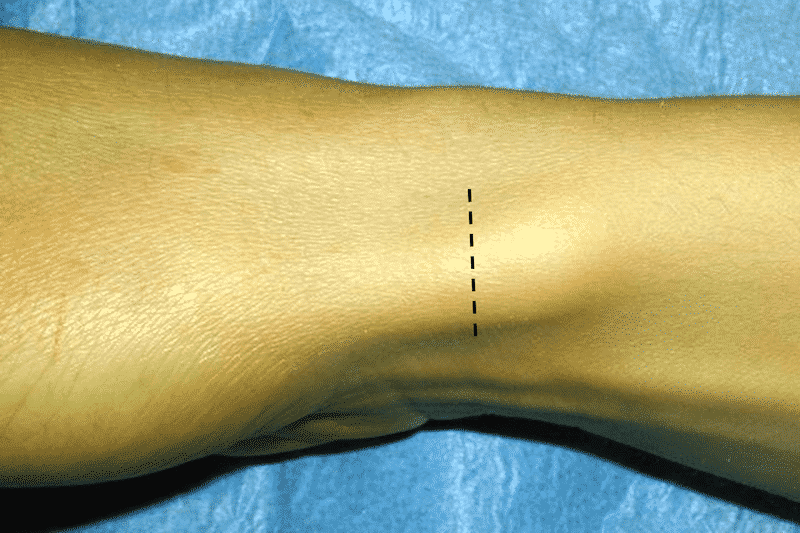 Quervain opération - incision zone de cicatrice pouce - zone de cicatrice après opération