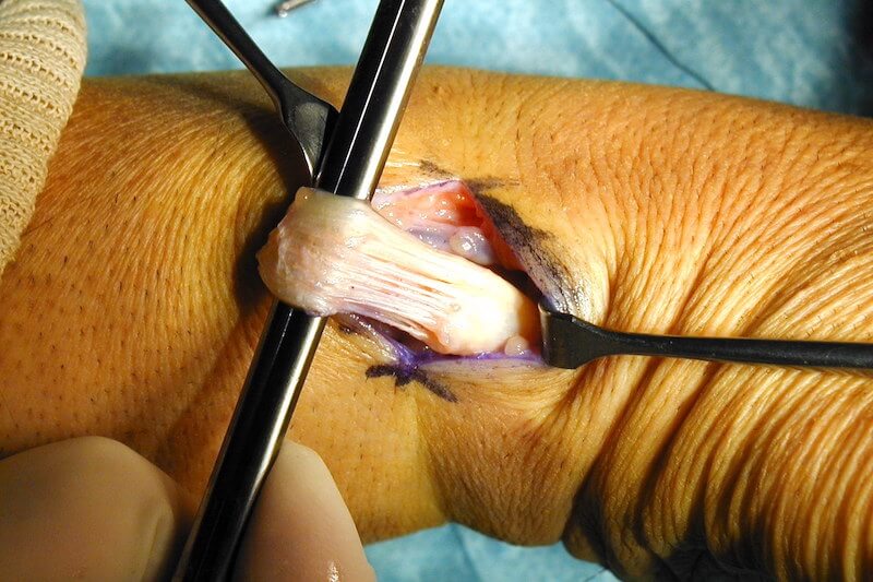 tendinite de quervain opération - vue tendon pouce abimé avant chirurgie du poignet