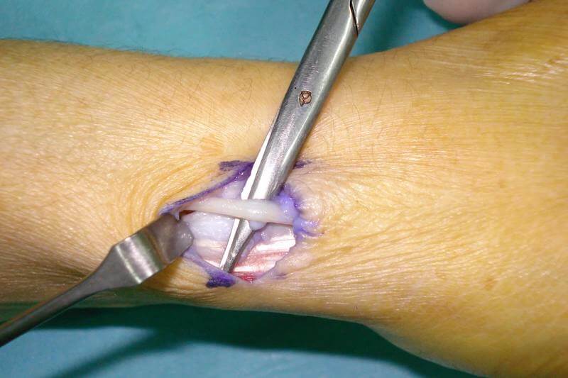 douleur apres operation tendinite de quervain - risque accident nerf radial pendant opération