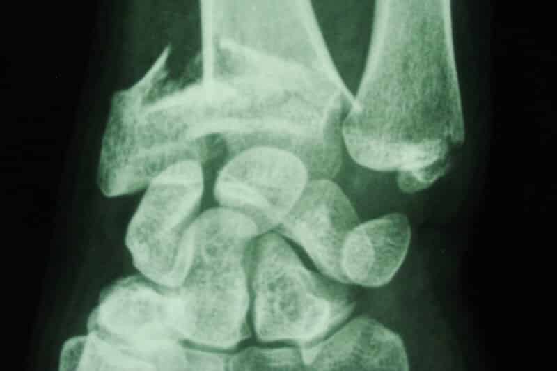 radiographie du poignet - radiographie de la main droite - fracture du poignet droit - traumatisme de la main droite