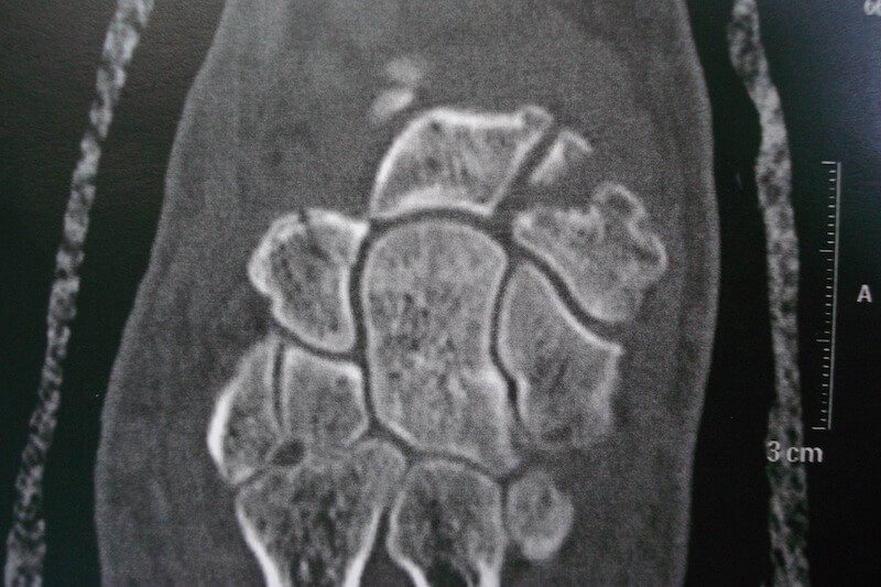 scanner poignet - scanner main - scanner du poignet droit - fracture du carpe os