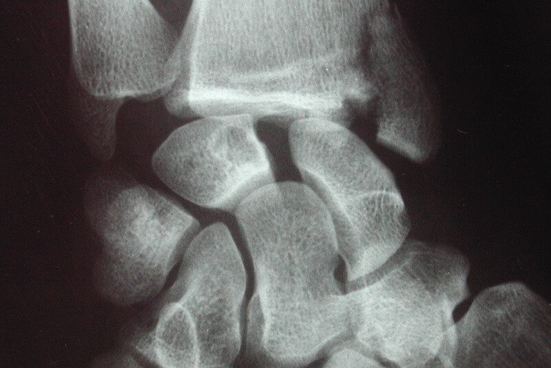 fracture articulaire poignet - fracture articulaire main - examen traumatisme du poignet grave radio