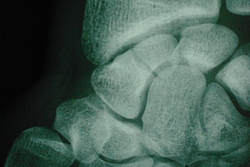 radio fracture poignet droit - fracture scaphoide poignet droit - traumatisme main