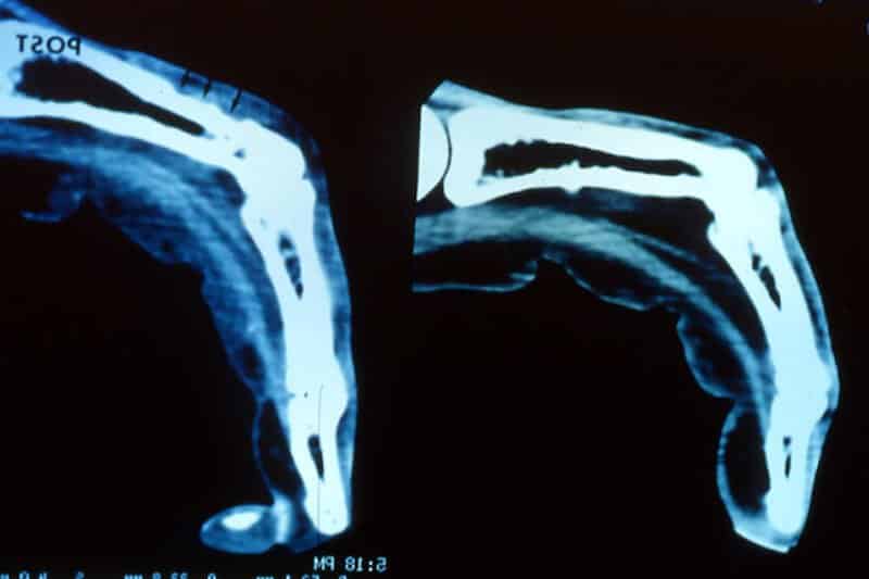 Fractures de la main, poignet et doigts