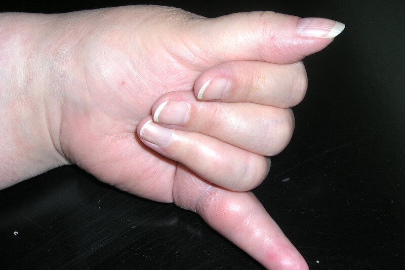 examen clinique de la main - maladie main gauche - main gonflée gauche - maladie rhumatismale des mains - rupture tendon fléchisseur 5 doigts