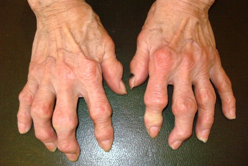 maladie des doigts déformés par l'arthrose avec nodules d Heberden et nodules de Bouchard