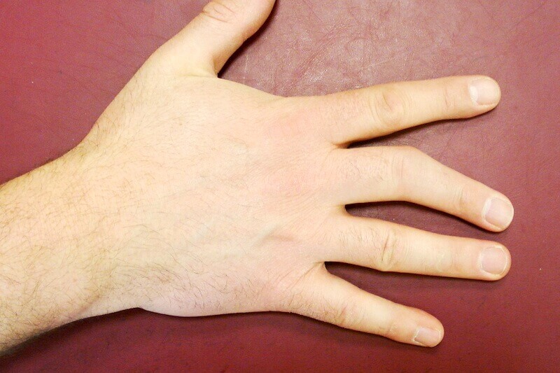 doigt tordu et désaxé - cause arthrose post traumatique