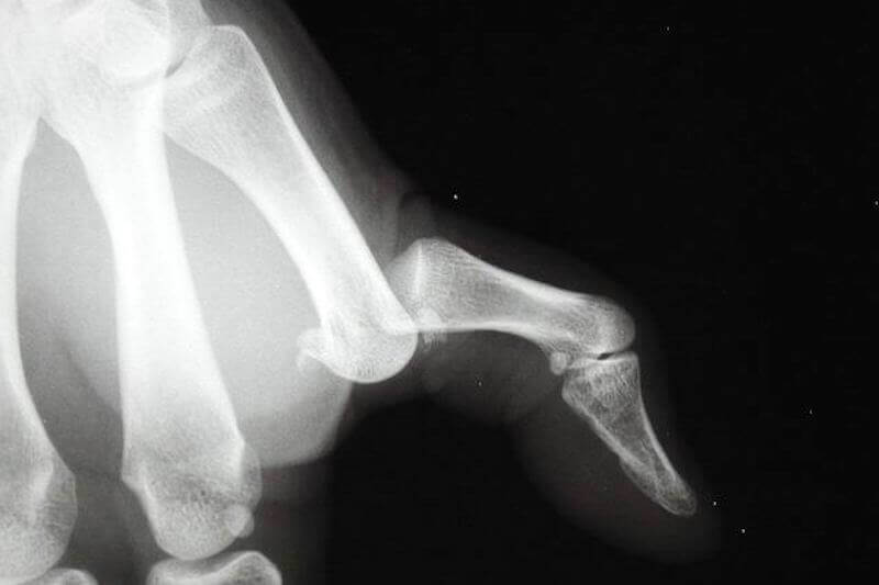 radiographie pouce - luxation du pouce de la main - que faire suite au traumatisme du doigt