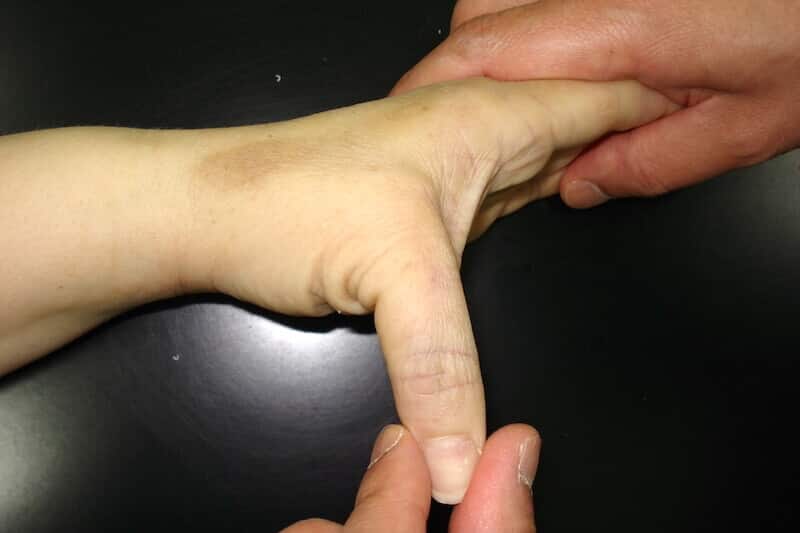 Traumatisme des doigts et traumatisme du pouce, Pathologies traumatiques  du doigt