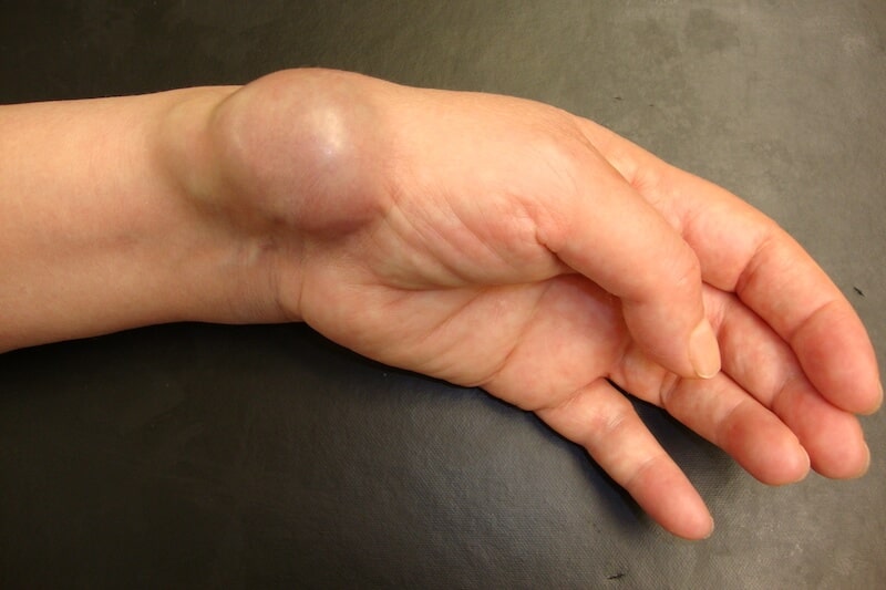 déformation et boule de kyste secondaire à une arthrose au niveau du poignet