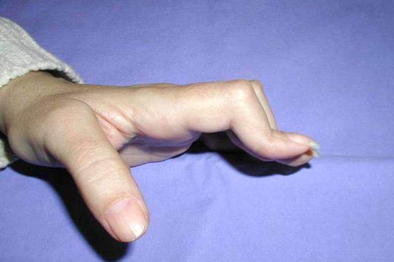 deformation doigt en boutonniere à cause de rupture tendon extenseur doigt