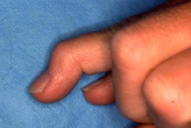 doigt déformé appelé doigt en maillet ou mallet finger - traumatisme au doigt de la main droite