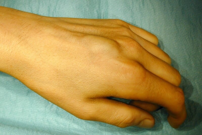 Boule sous la peau - Kyste sur tendon extenseur du doigt