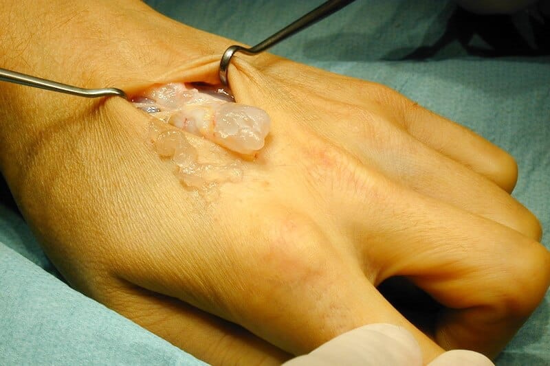 traitement chirurgical et exérèse du kyste intra-tendineux dos du poignet