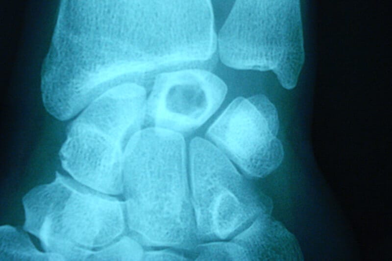 radiographie kyste intra osseux poignet appelé lacune osseuse