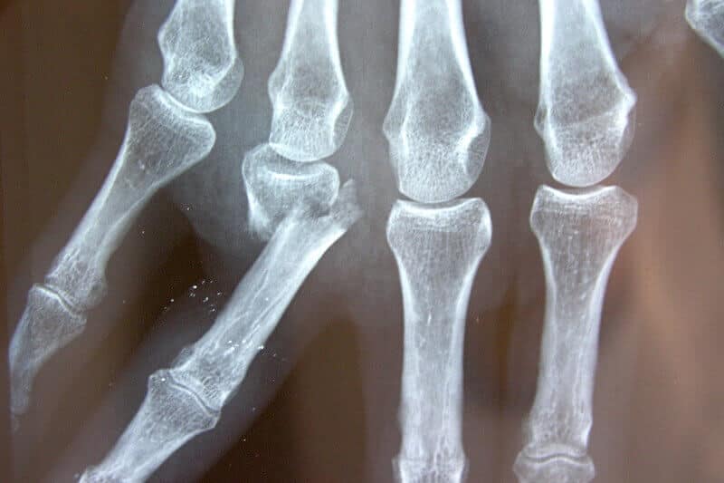 radiographie fracture doigt - fracture premiere phalange après traumatisme