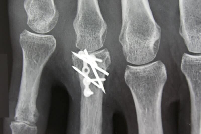 radiographie ostheosynthese doigt - chirurgie du doigt suite fracture de phalange