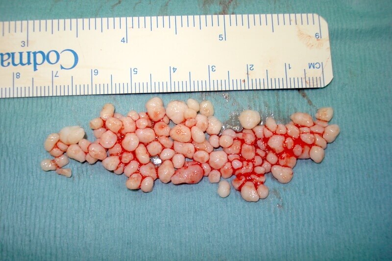 chondromatose synoviale doigt - grains de riz ou cailloux de cartilage