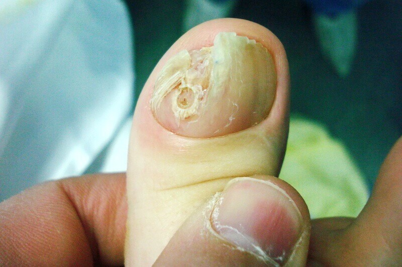 maladie ongle doigt de la main causée par mycose des doigts