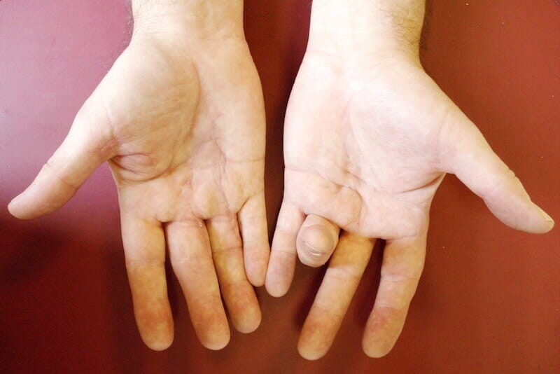 maladie de dupuytren - corde rétractile du doigt appelée corde de dupuytren