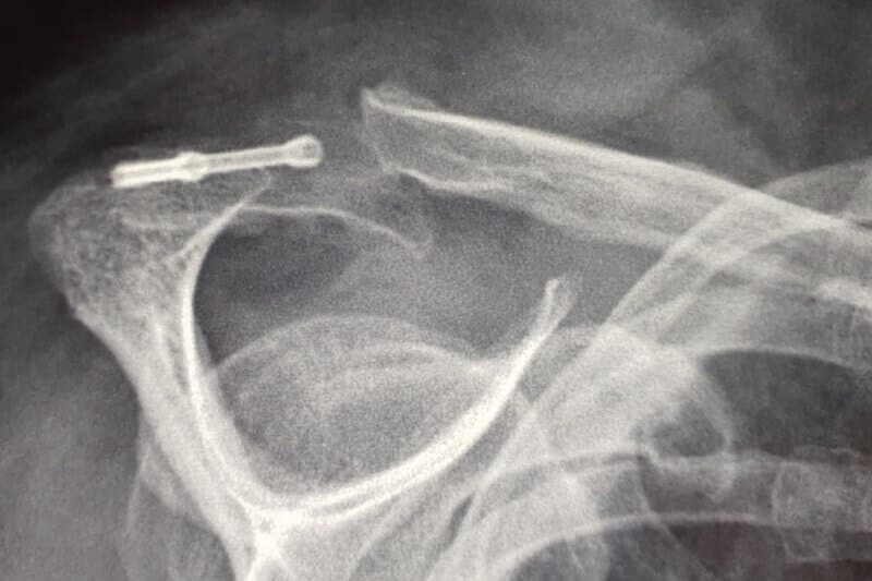 radiographie epaule - acromion fracture