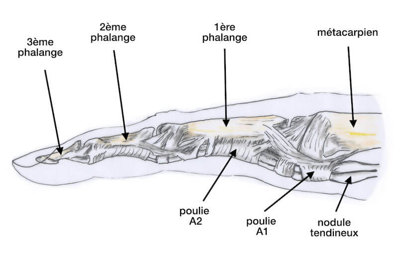 Positionnement de la poulie A1 sous laquelle les tendons fléchisseurs n'arrivent pas à coulisser correctement