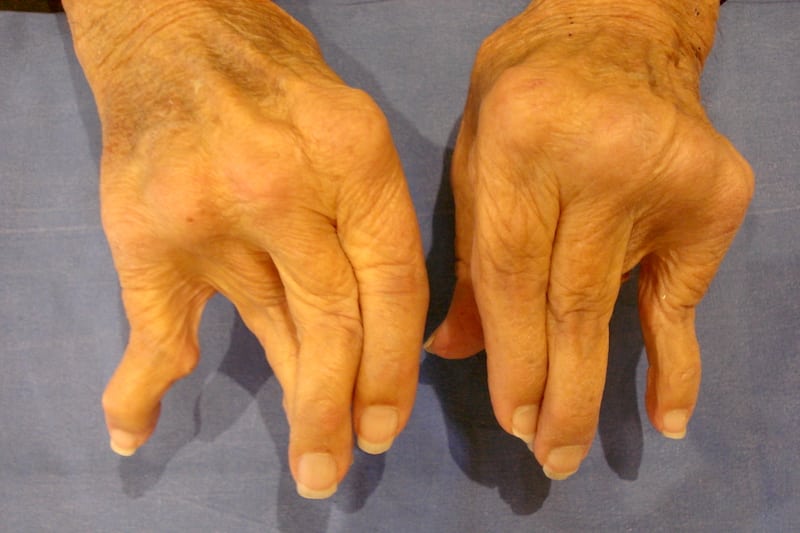 Polyarthrite rhumatoïde où l'opération d'un doigt à ressaut devient plus complexe