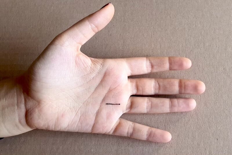 Un tracé d'incision longitudinale d'un 4ème de doigt à ressaut