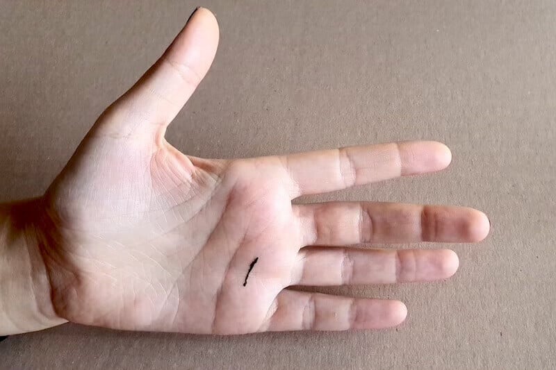 Un tracé d'incision transversale d'un 4ème de doigt à ressaut