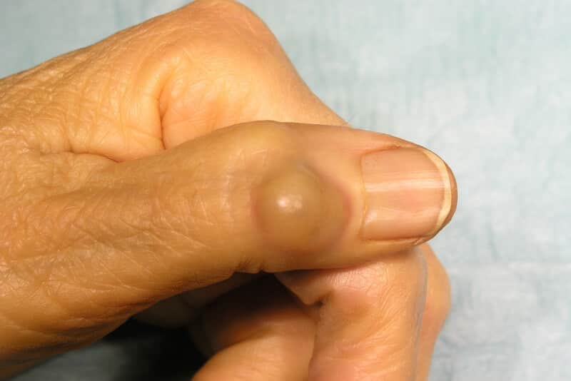 Kyste mucoïde au doigt | Maladie des doigts de la main | Pr Eric ...