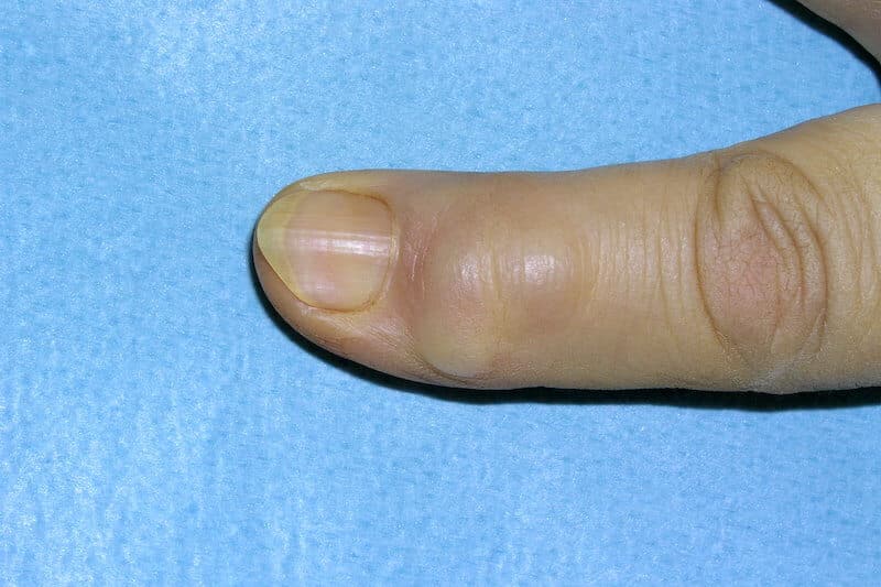 Kyste mucoïde au doigt | Maladie des doigts de la main | Pr Eric ...