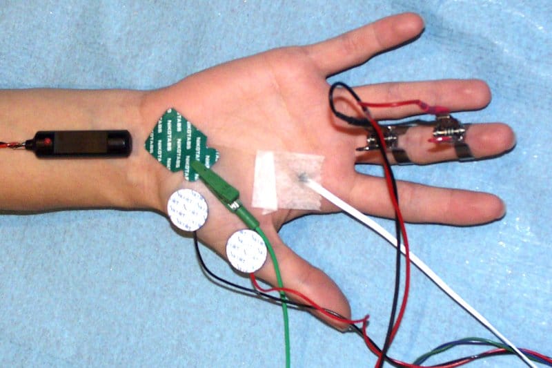 emg canal carpien - electromyogramme de la main