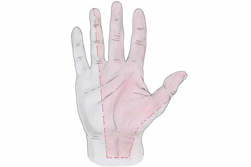 symptome canal carpien - zone fourmillements et douleurs des doigts de la main