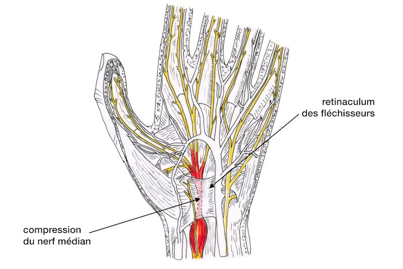 anatomie du canal carpien - compression du nerf median au niveau du poignet