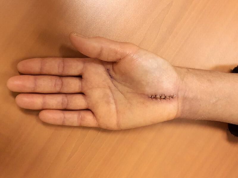 Cicatrice d'une chirurgie de la main à ciel ouvert