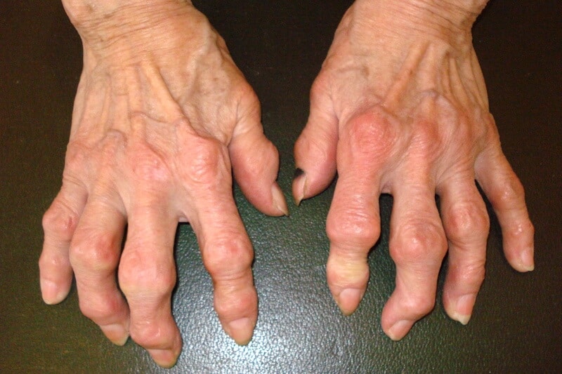 Arthrose bilaterale main doigts