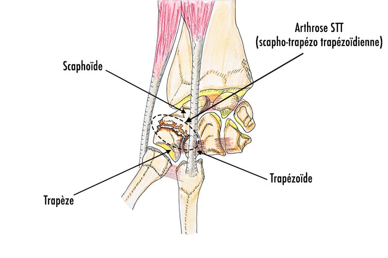 Anatomie-main-droite-vue-palmaire-rhizarthrose-et-arthrose-stt-scapho trapézo trapézoïdienne