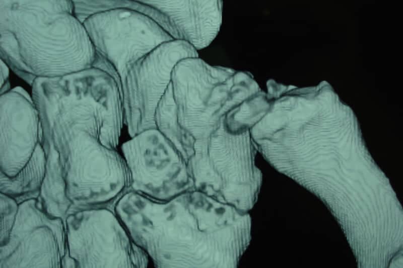 3D dysplasie arthrose main